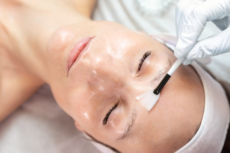 Rejuvenate Your Skin with the Magic of Skin Peels