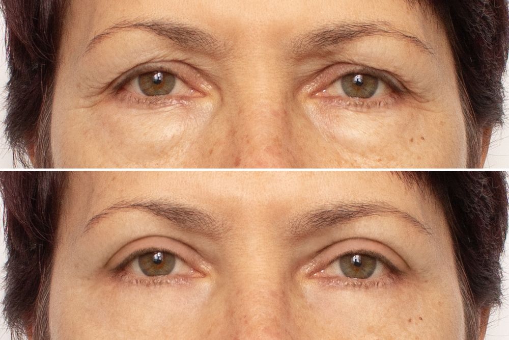 Botox Before and After