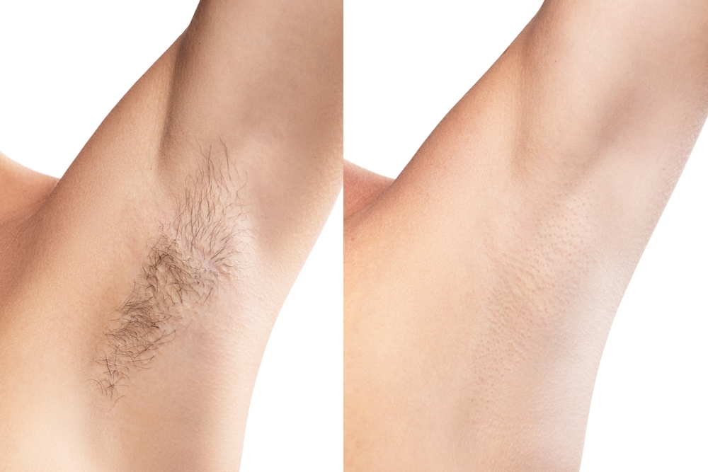 Laser Stretch Mark Removal