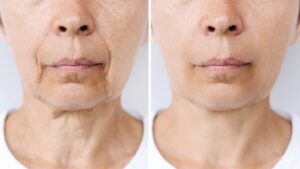 Laser Treatment for Dark Spots