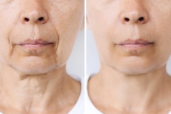 Laser Treatment for Dark Spots