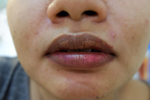 Can Vaseline Remove Dark Lips