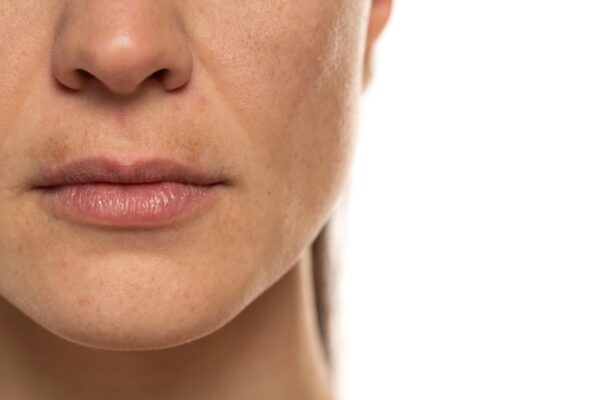 Laser Treatment for Fine Lines
