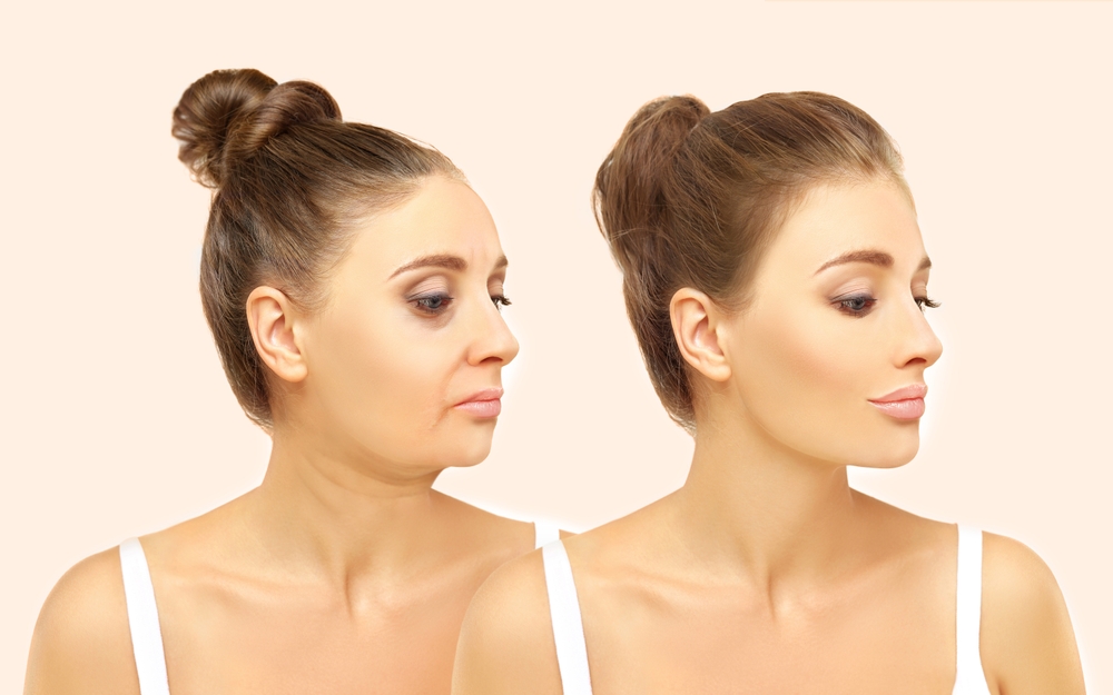 Laser Treatment for Melasma
