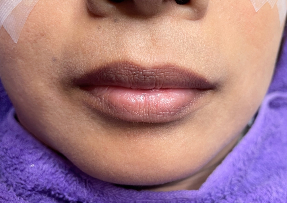 Dark Lips Treatment