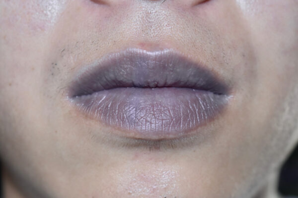 Dark Lips Removal Treatment