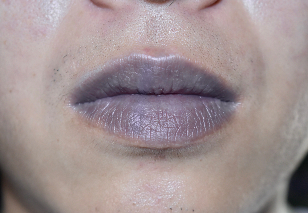 Dark Lips Removal Treatment