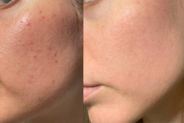 Laser Treatment for Open Pores