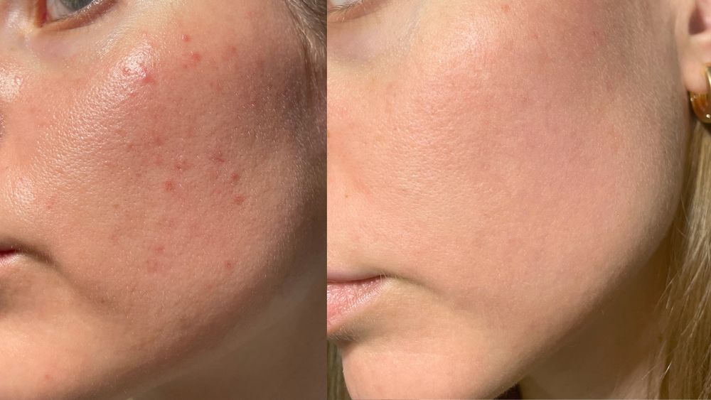 Laser Treatment for Open Pores