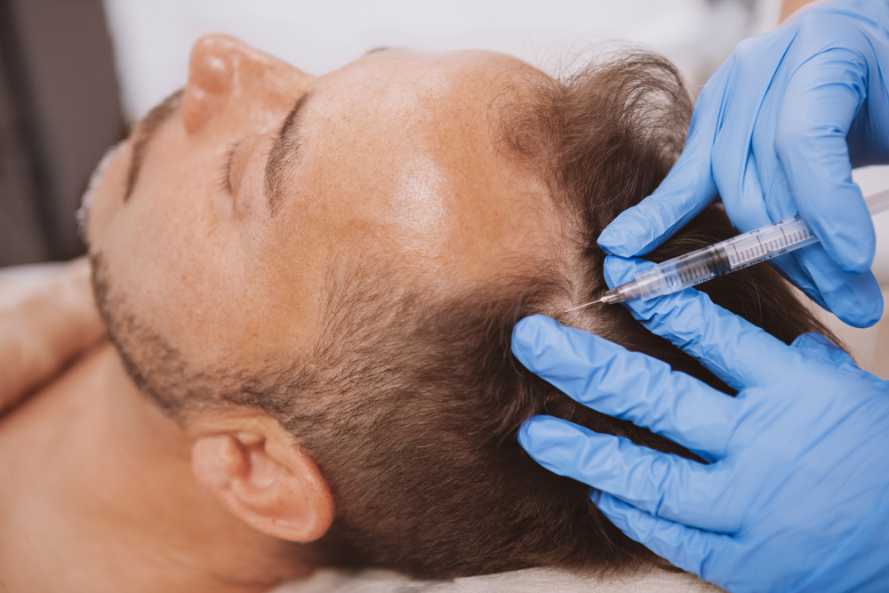 Can PRP Regrow Hair